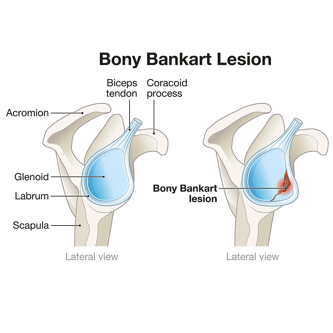 Bony bankart lesion in the shoulder, illustration