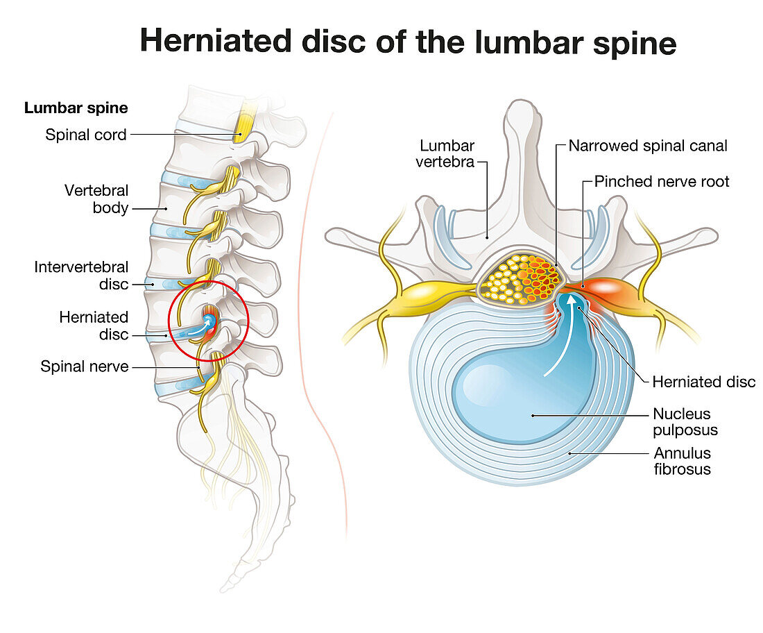 Herniated disc of the lumbar spine, illustration