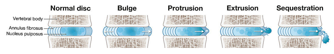 Herniated disc, illustration