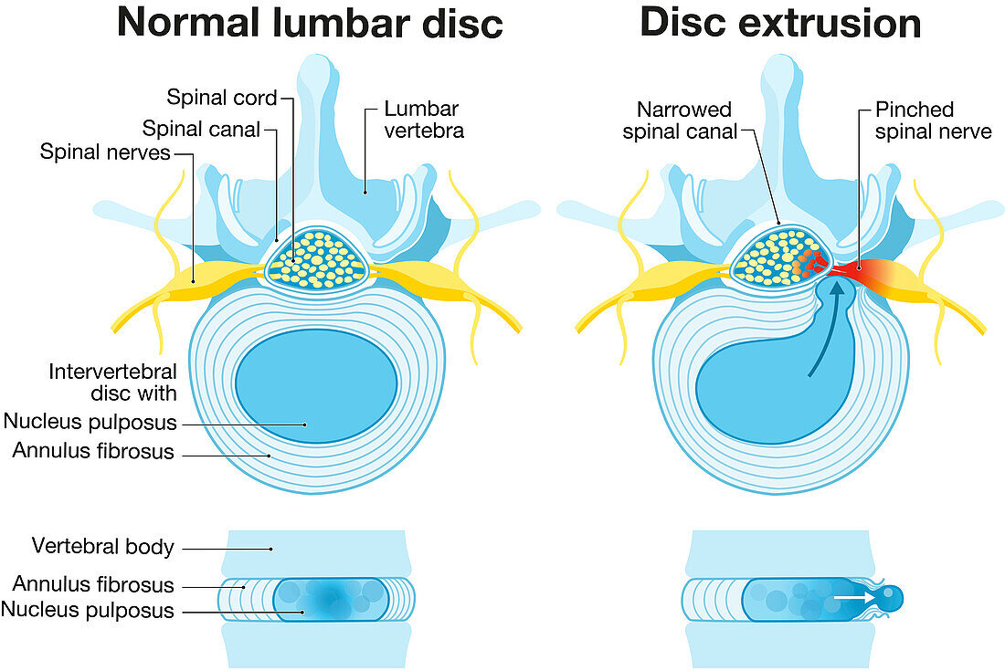 Normal disc and herniated disc, illustration