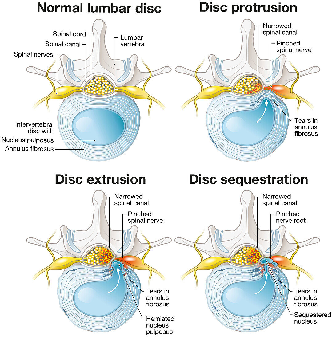Herniated disc progression, illustration