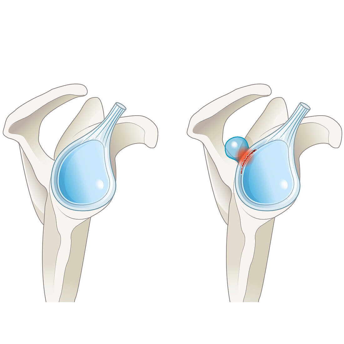 SLAP lesion paralabral cyst in the shoulder, illustration