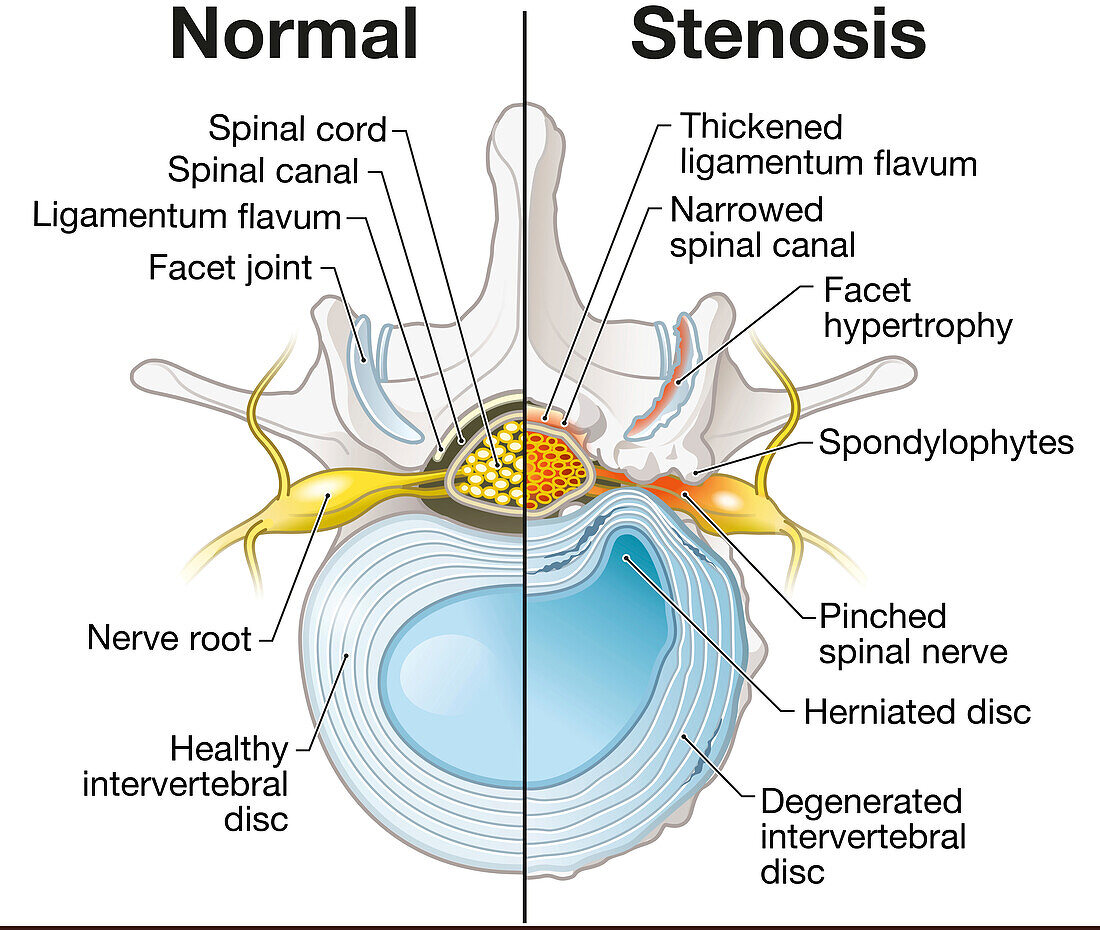 Spinal canal stenosis, illustration