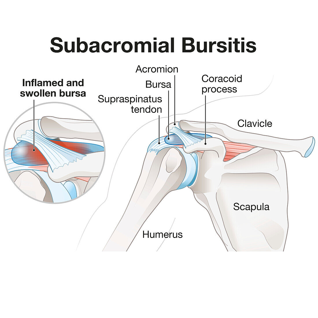Subacromial bursitis of the shoulder, illustration