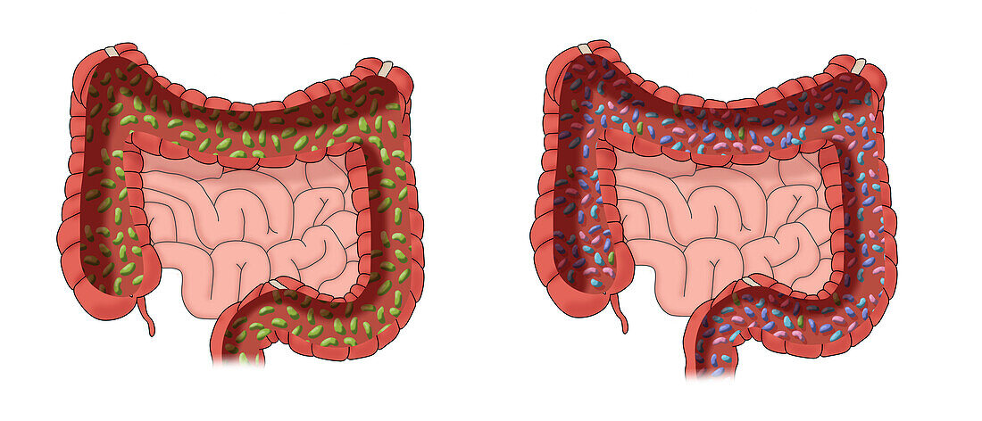 Unhealthy and healthy bacteria in the intestine, illustration