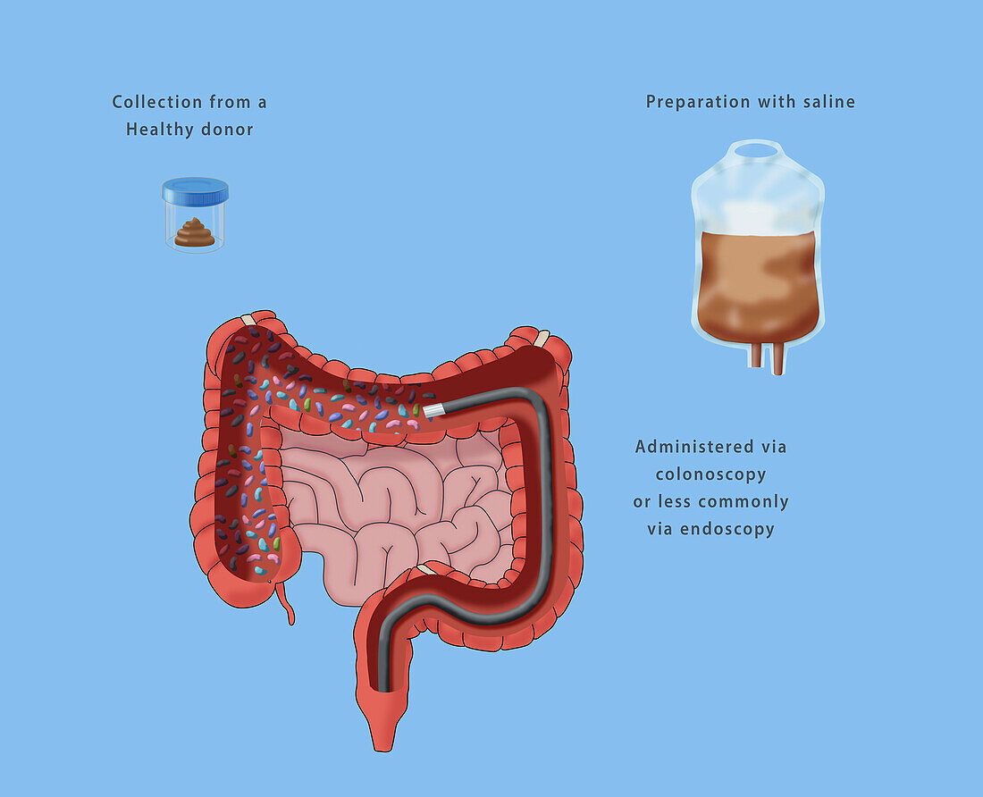 Faecal microbiota transplantation, illustration