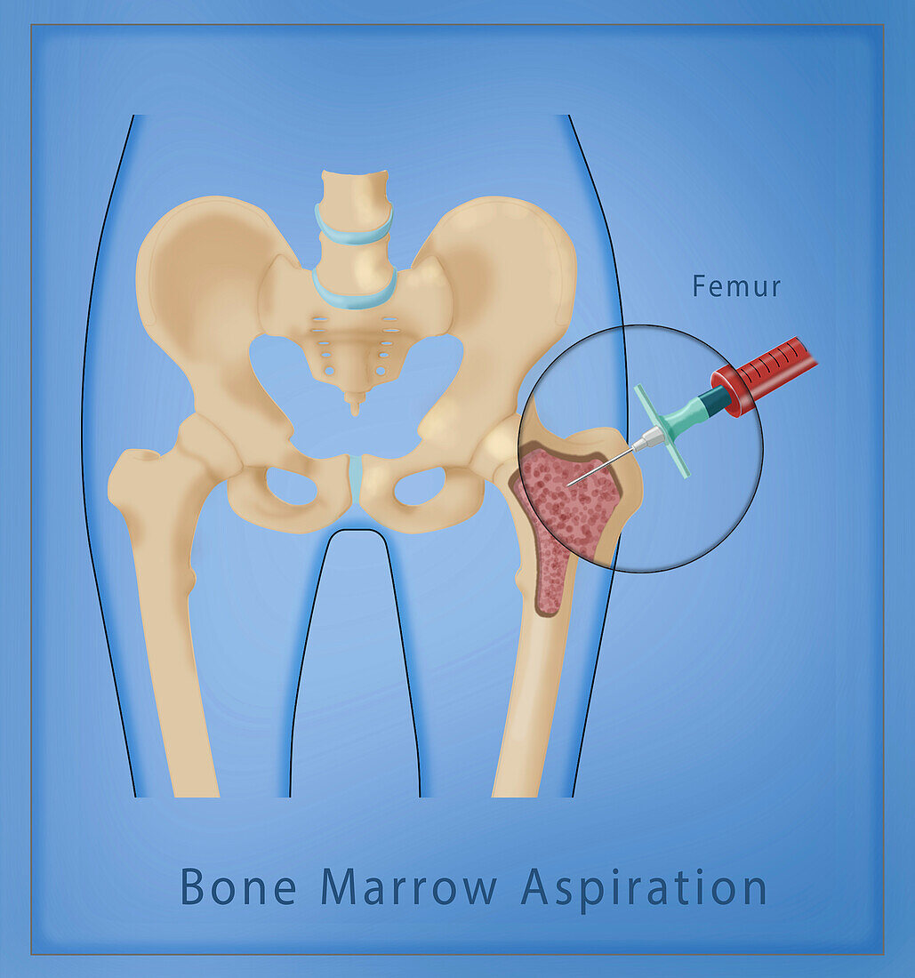 Bone marrow aspiration from the femur, illustration