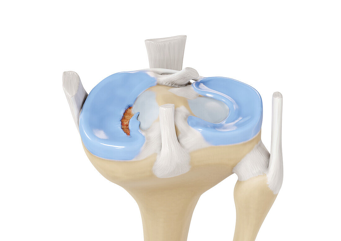 Flap tear meniscus, illustration