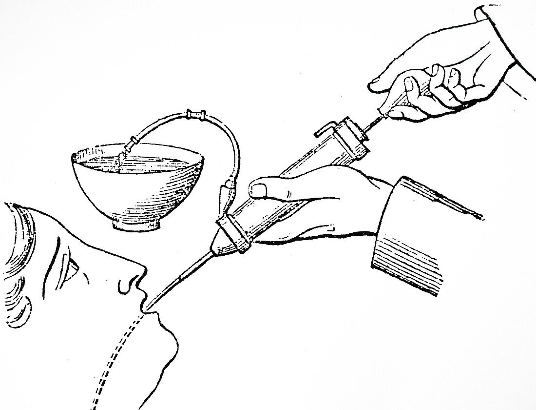 Reed's syringe, illustration