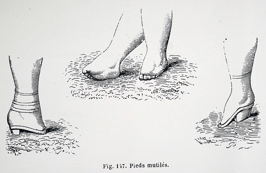 Consequences of foot binding in China, illustration