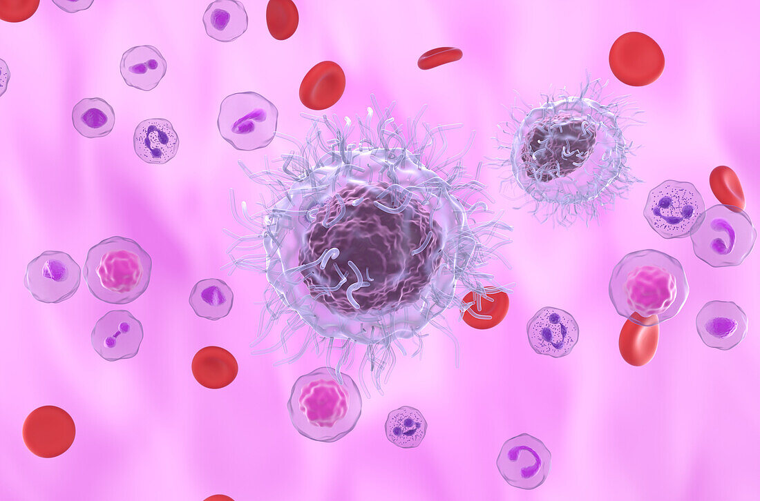 Hairy cell leukaemia, illustration