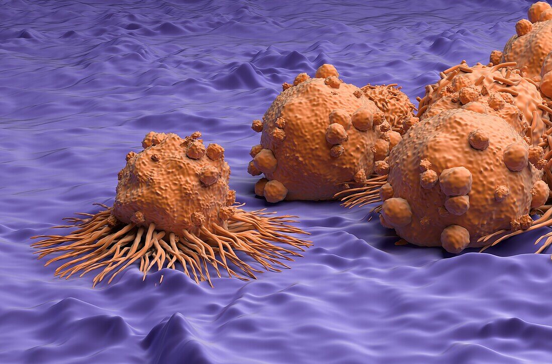 Kidney cancer cells, illustration