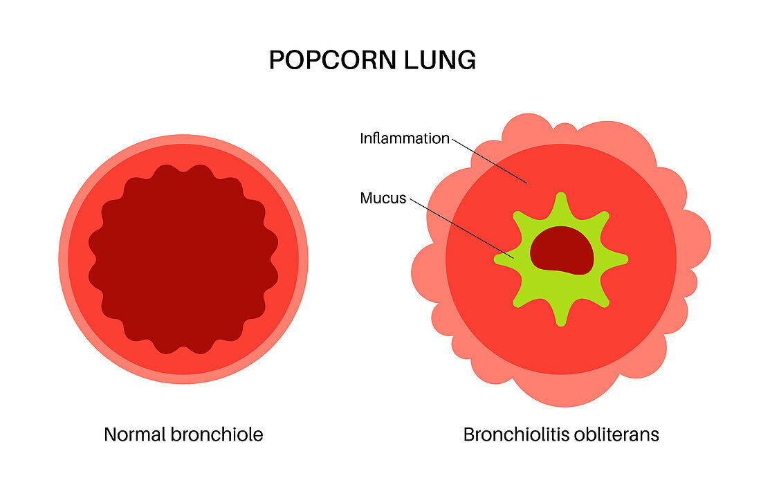 Popcorn lung disease, illustration