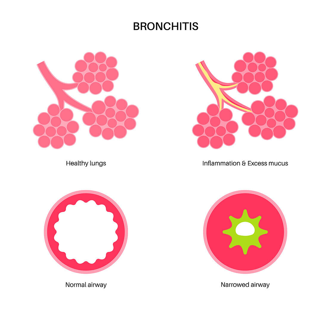 Bronchitis lung disease, illustration