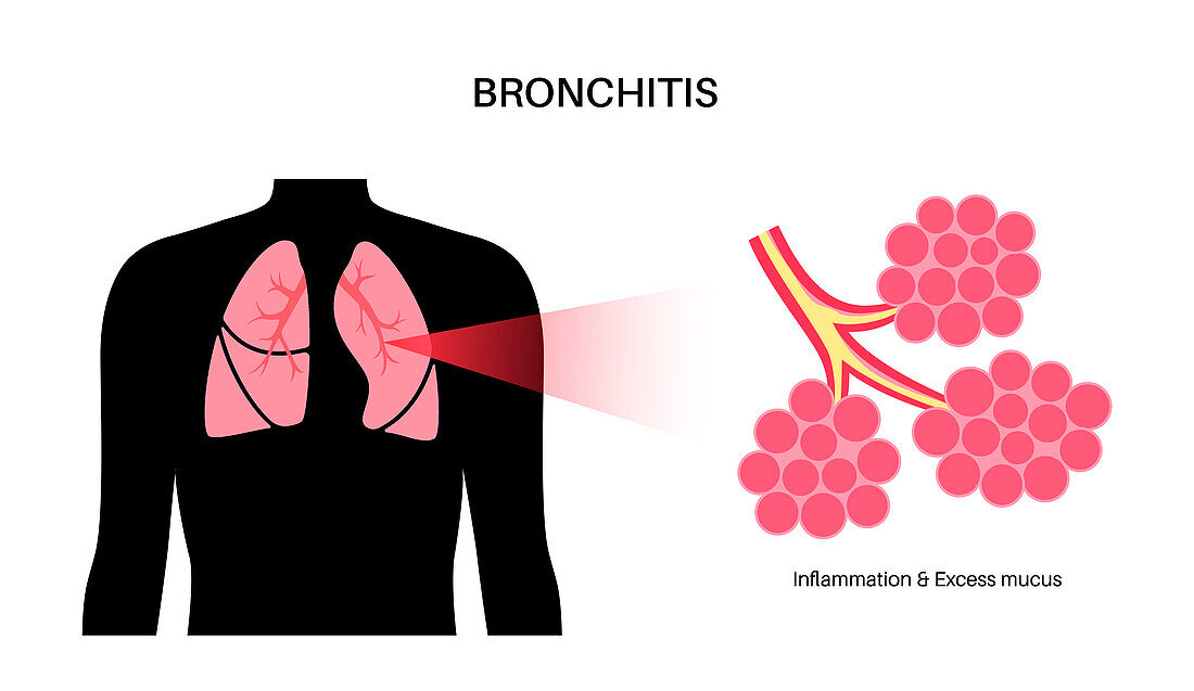 Bronchitis lung disease, illustration