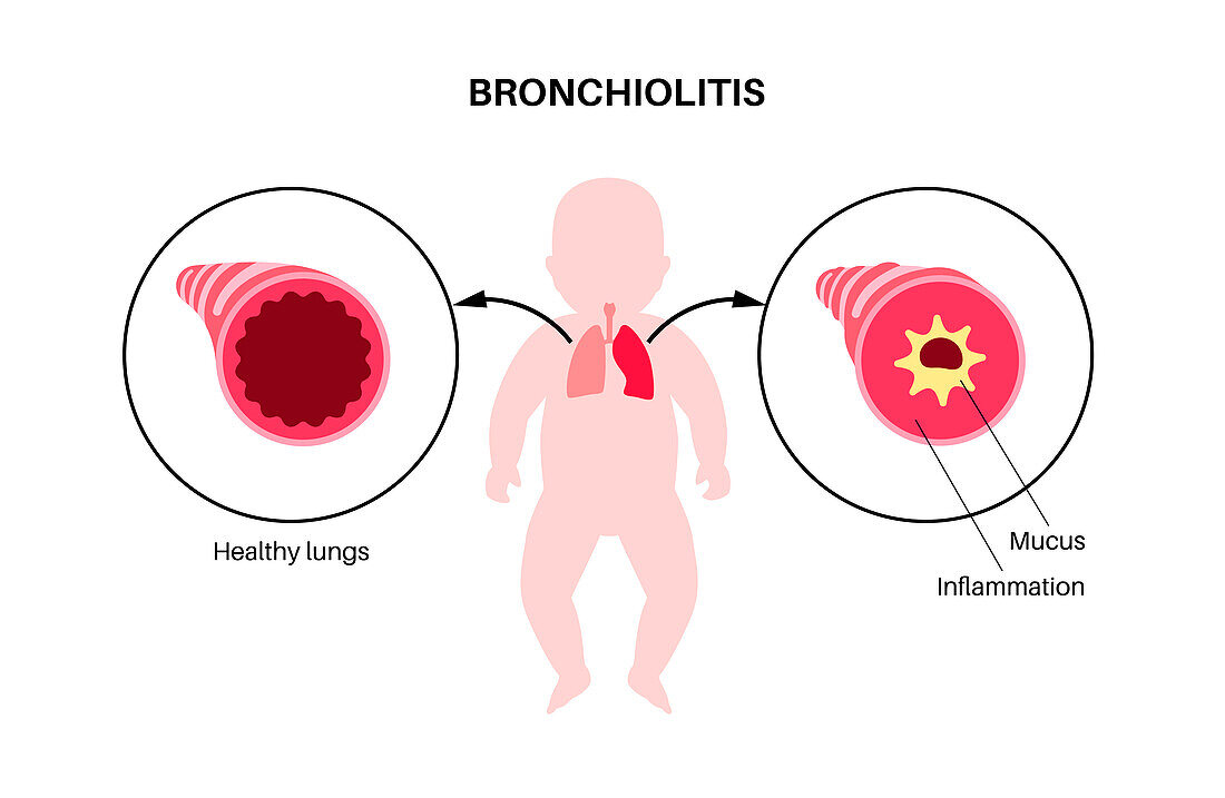 Bronchiolitis lung disease, illustration