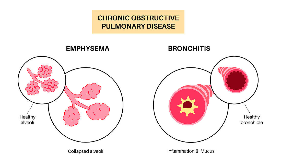 Chronic obstructive pulmonary disease, illustration