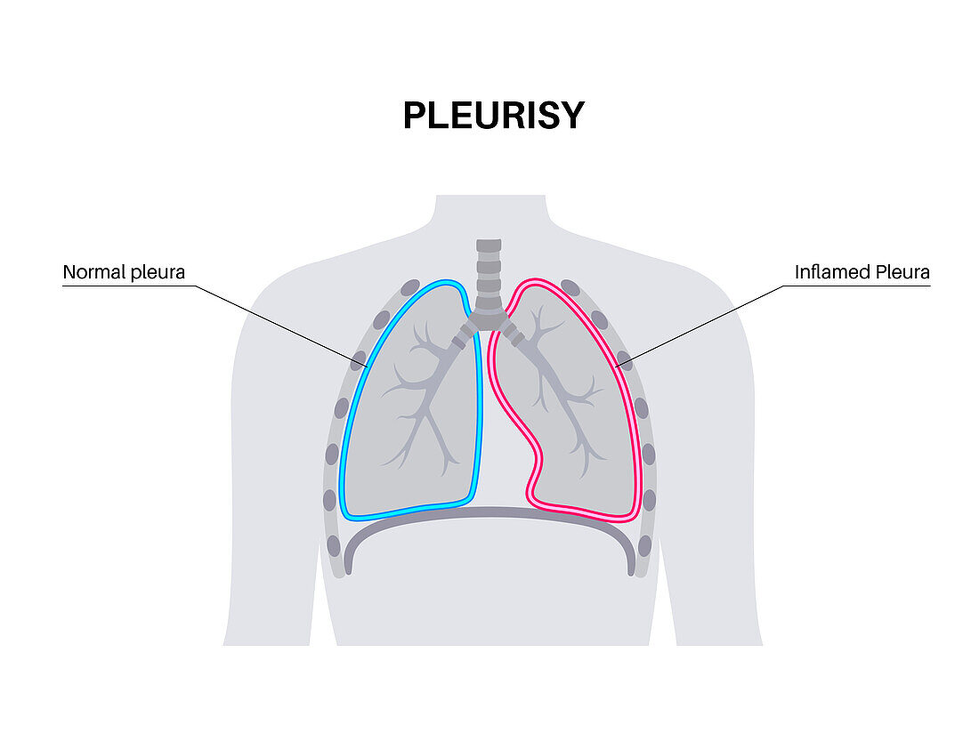 Pleurisy, illustration