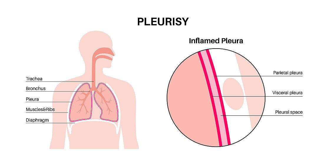 Pleurisy, illustration