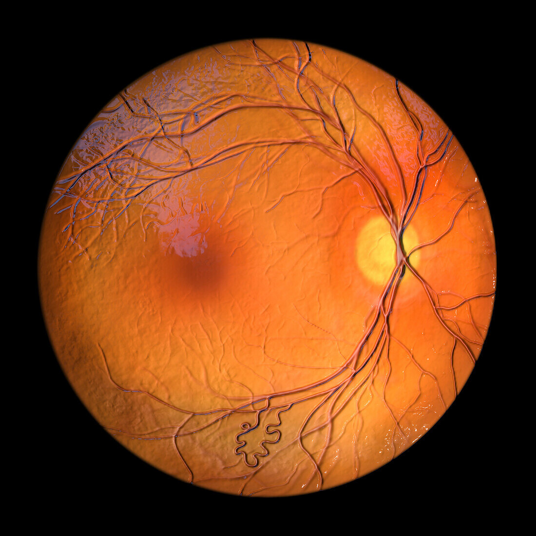 Retinal arteriovenous malformation, illustration