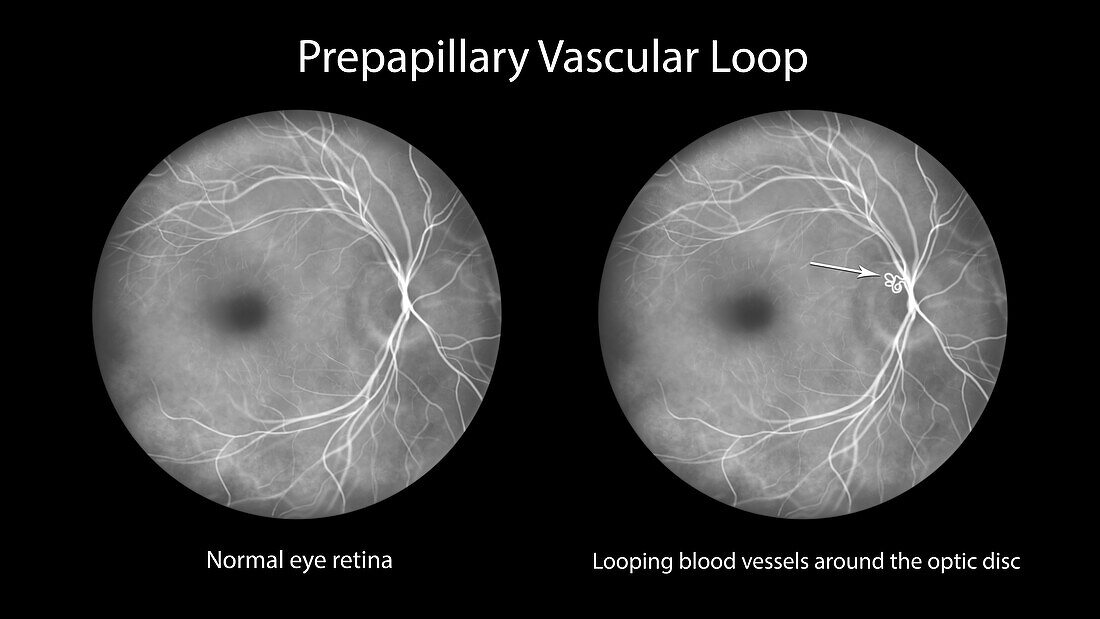 Prepapillary vascular loop on the retina, illustration