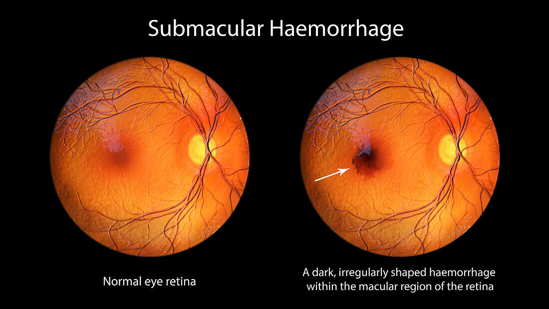 Submacular haemorrhage on the retina, illustration