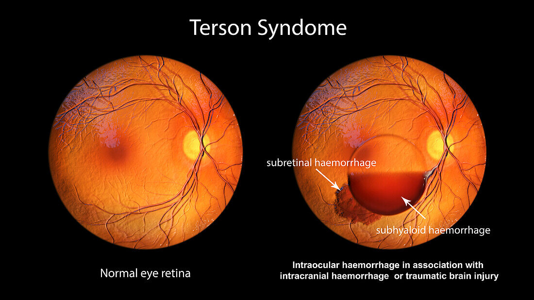 Intraocular haemorrhage in Terson syndrome, illustration