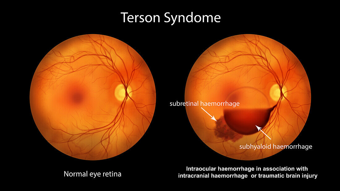 Intraocular haemorrhage in Terson syndrome, illustration