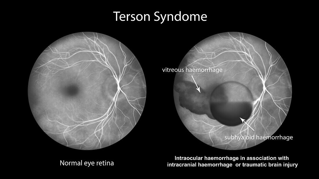 Intraocular haemorrhage in Terson syndrome, illustration