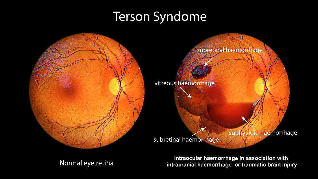 Intraocular haemorrhage in Terson syndrome, illustration