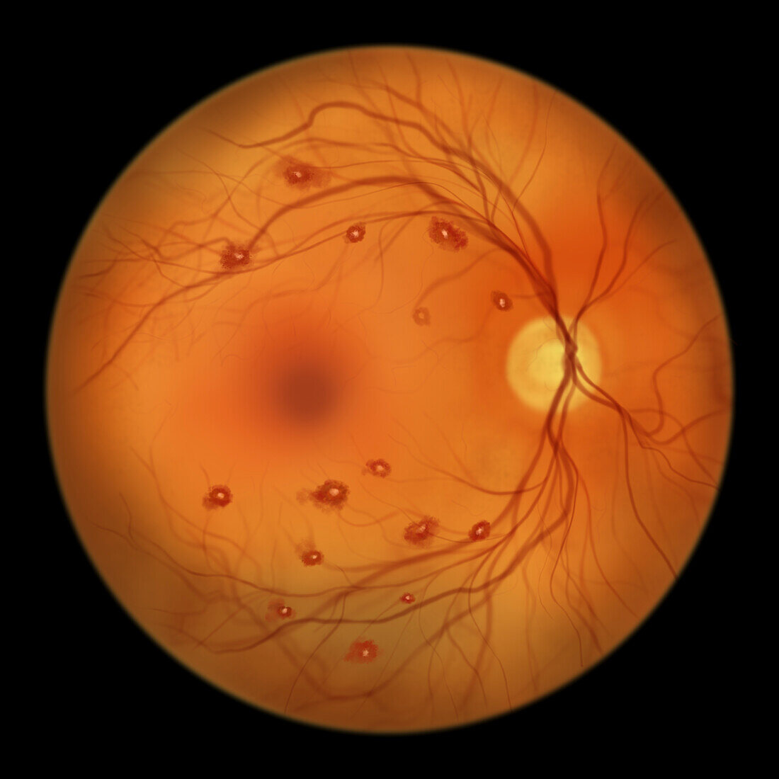 Roth spots in the retina, illustration