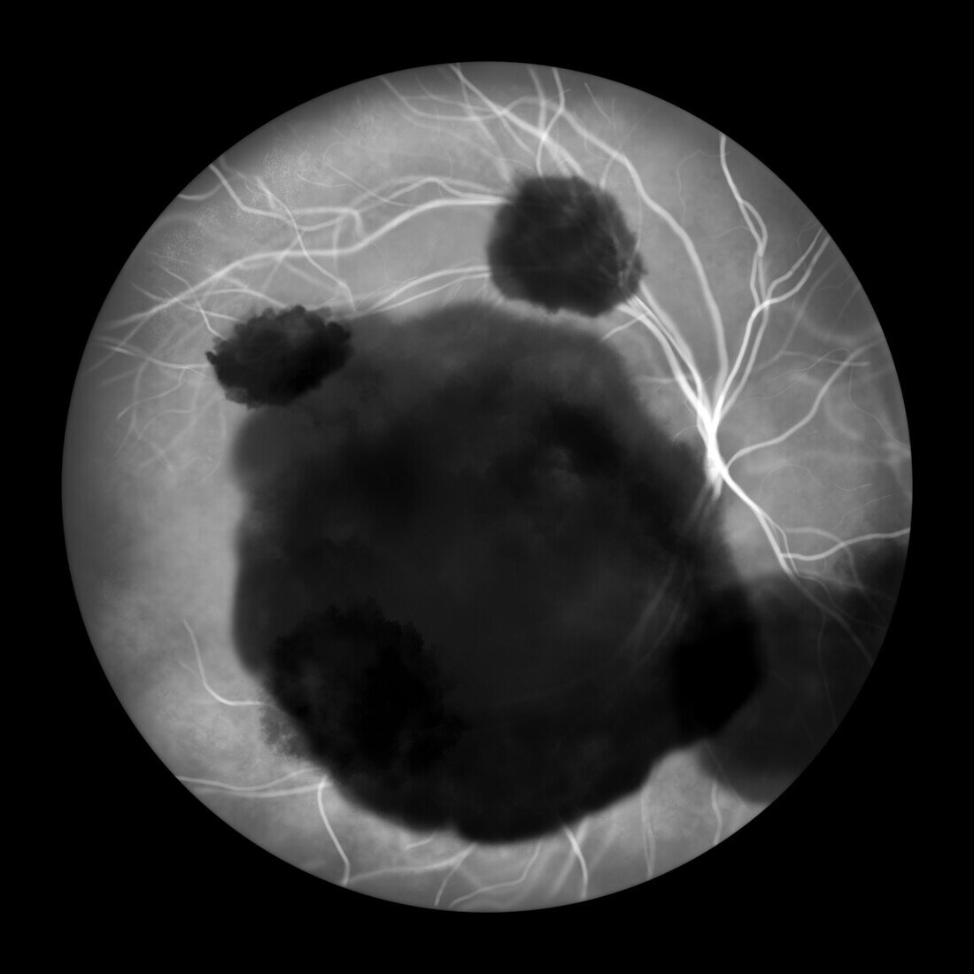 Subretinal haemorrhage, illustration