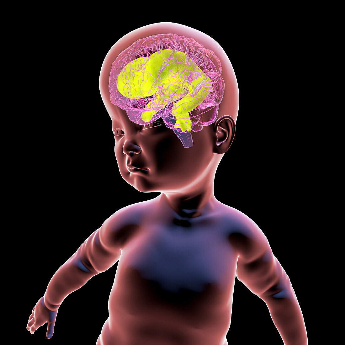 Baby with enlarged brain ventricles, illustration