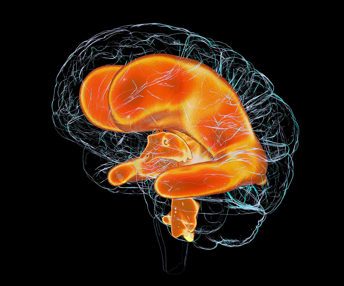 Enlarged ventricles of a child's brain, illustration