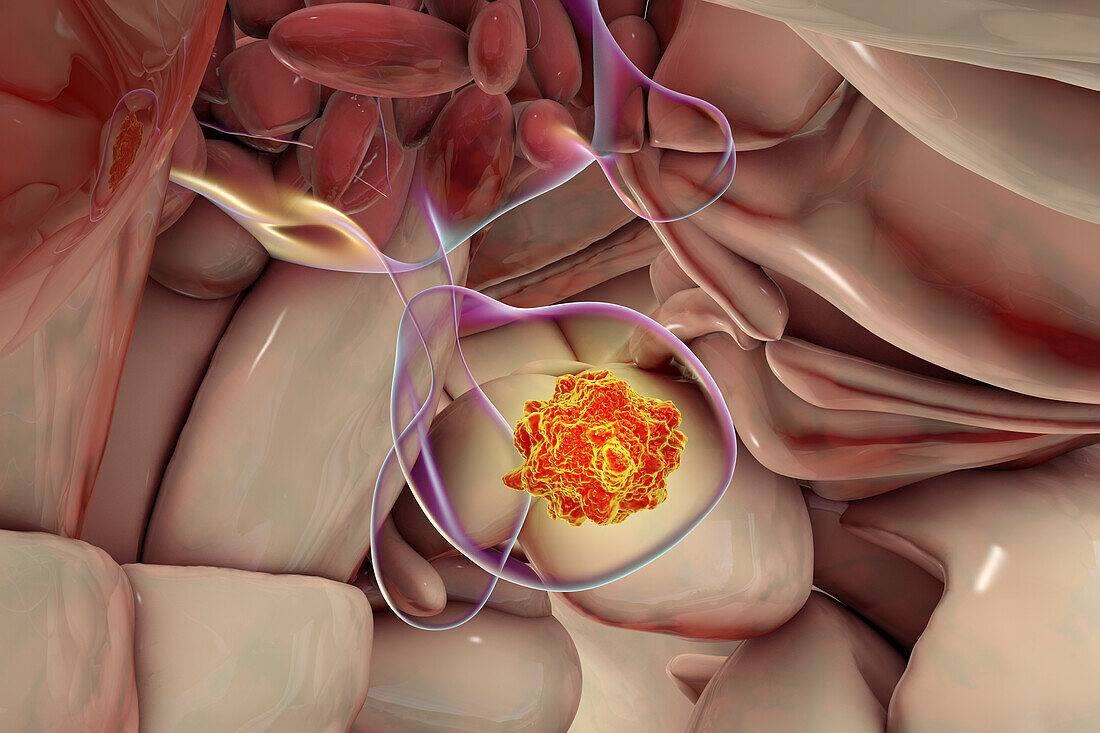 Pituitary gland tumour, illustration