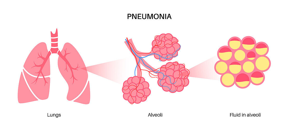 Pneumonia, illustration