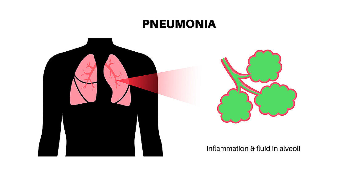 Pneumonia, illustration