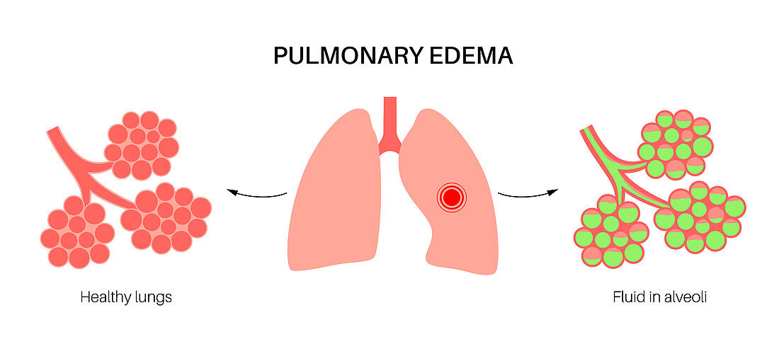 Pulmonary oedema, illustration
