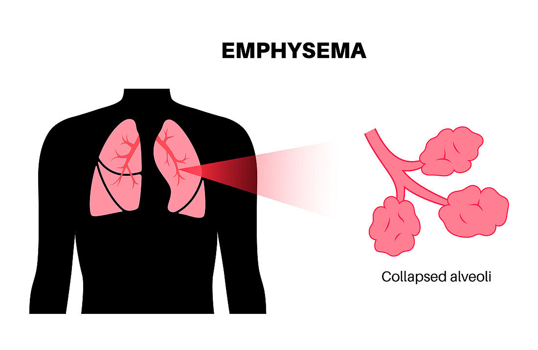 Emphysema, illustration