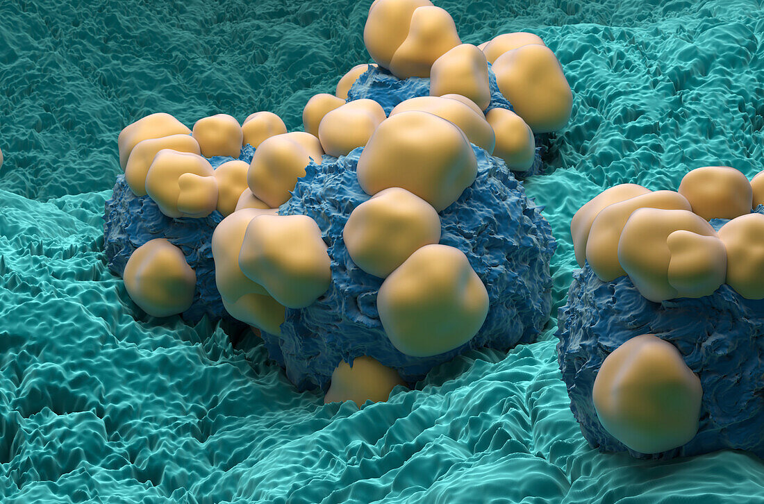 Adenocarcinoma cells, illustration