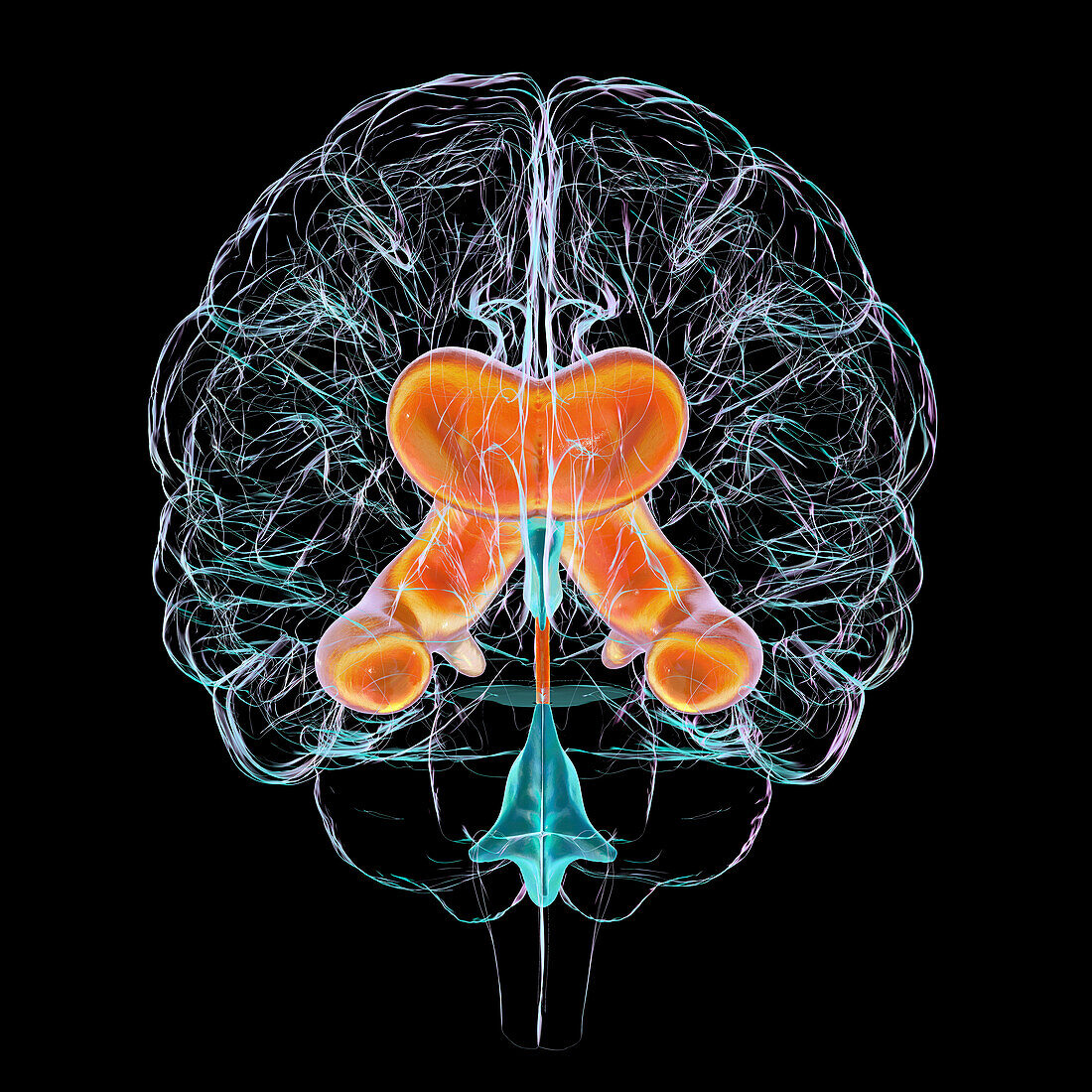 Enlarged lateral ventricles of the brain, illustration