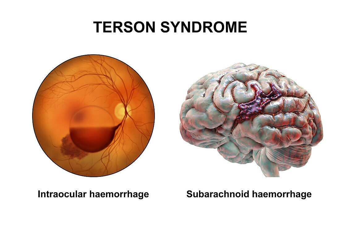 Terson syndrome, illustration