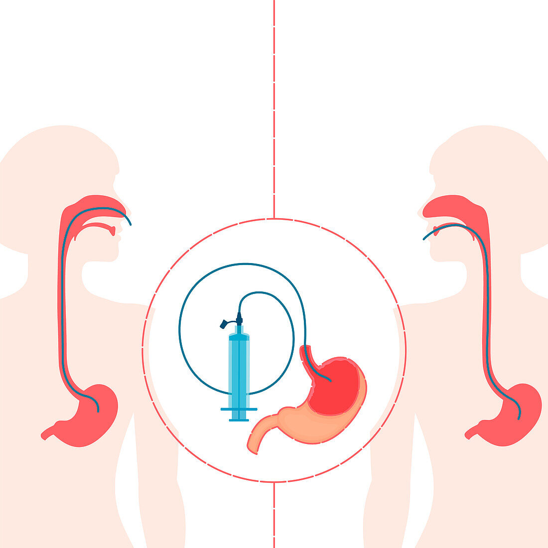 Enteral feeding tubes, conceptual illustration