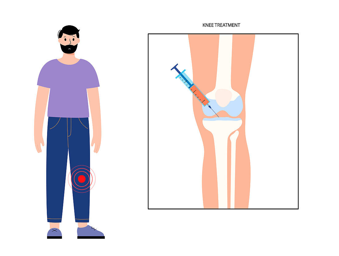 Injection for knee pain, illustration