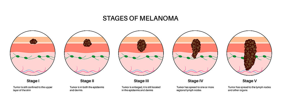 Melanoma stages, illustration