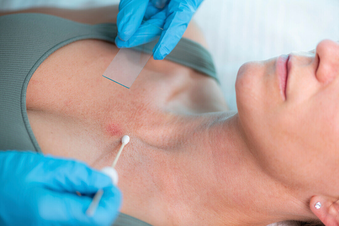 Dermatologist taking skin sample