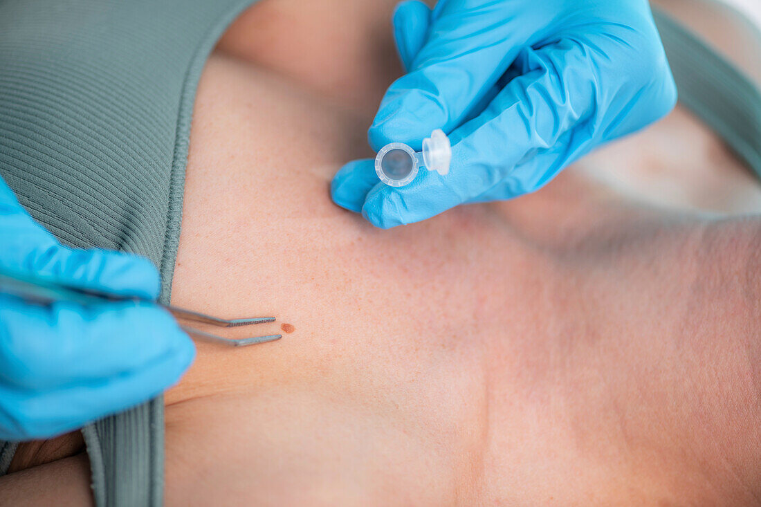 Dermatologist taking skin sample