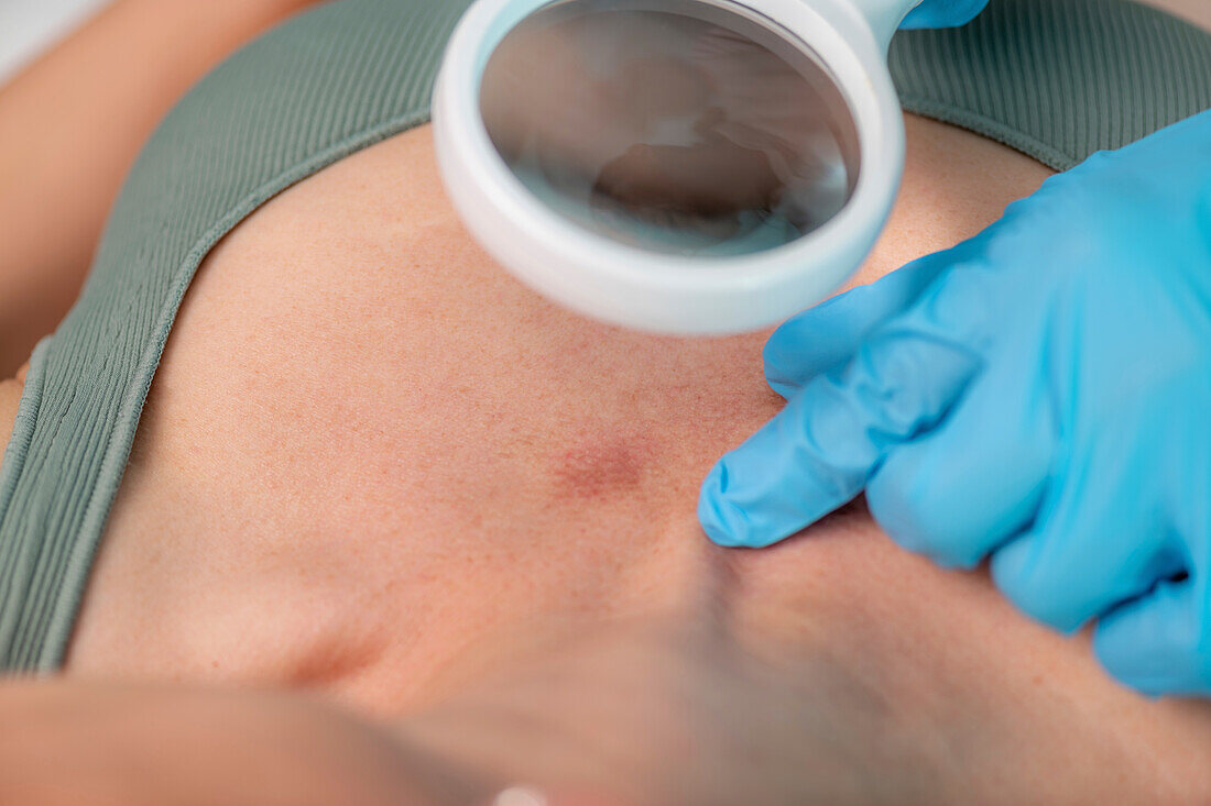 Dermatologist checking skin lesion