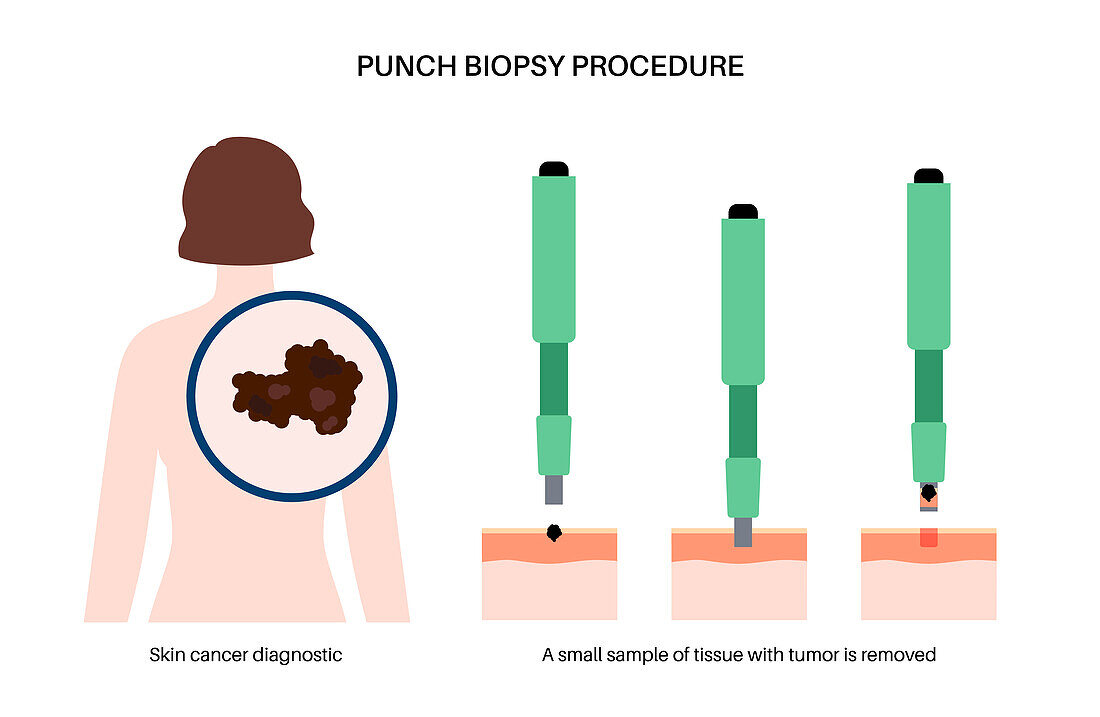 Punch biopsy, illustration