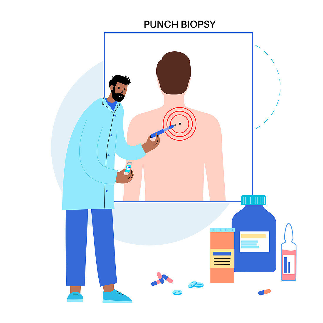 Punch biopsy, illustration